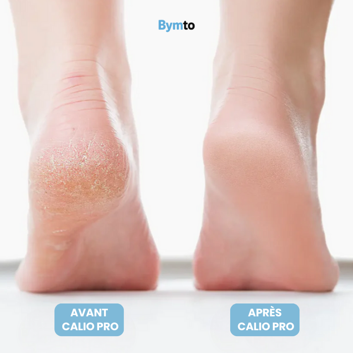 CALIO PRO®|Râpe électrique anti-callosités